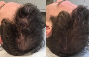 Think Ink Micro-Esthetics SMP Miami Alopecia Scalp Micropigmentation Norwood 7 Hair Loss Hair Transplant hair thinning baldness 