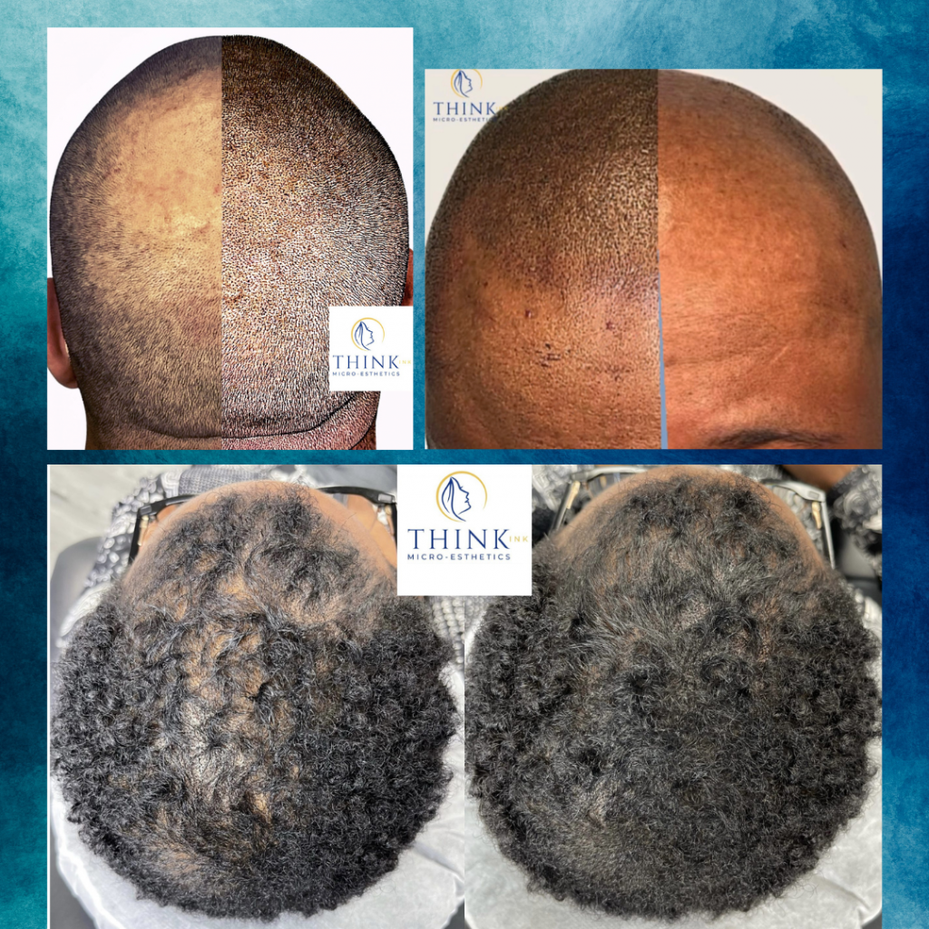 Think Ink Micro-Esthetics Scalp Micropigmentation for Hair Loss
