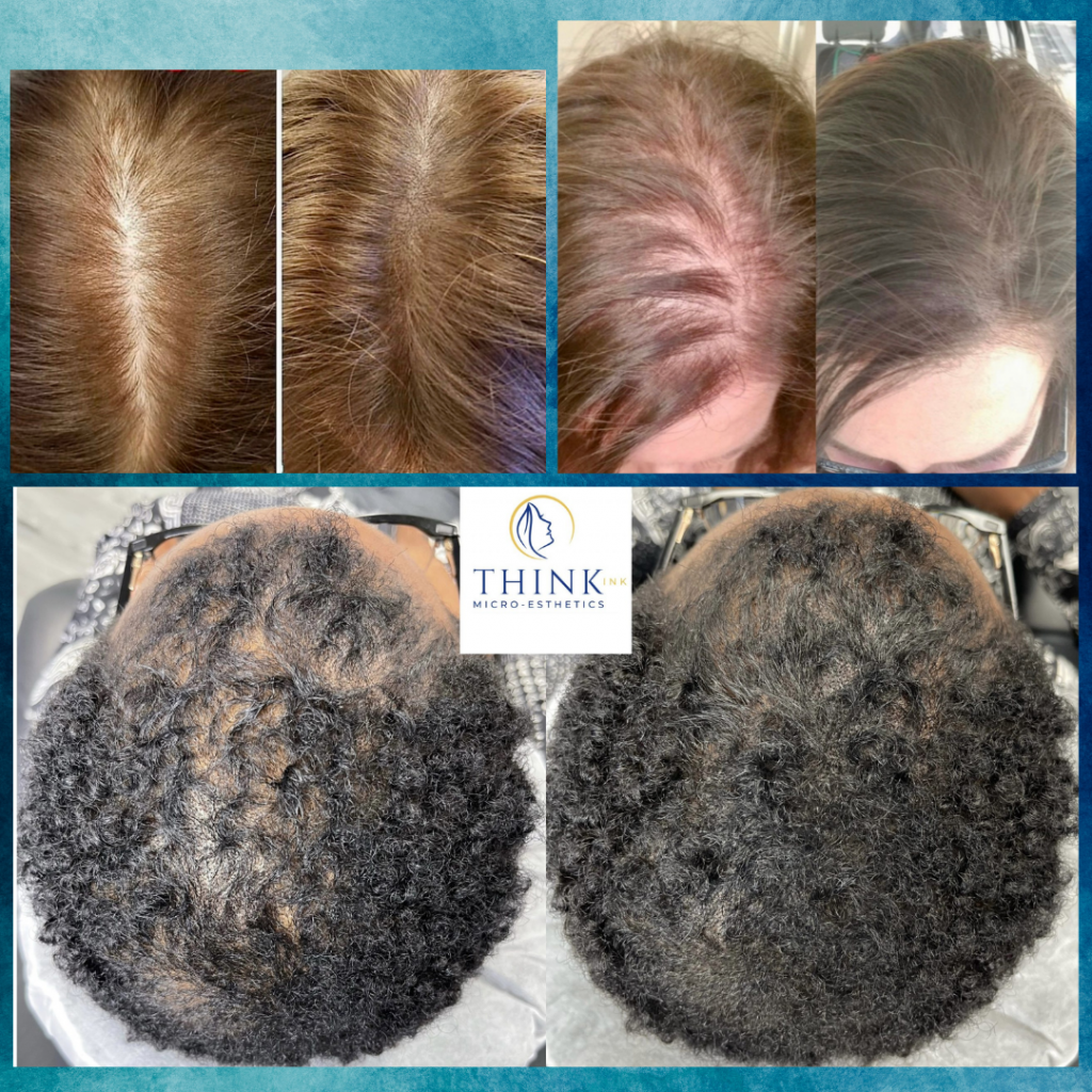 Think Ink Micro-Esthetics Scalp Micropigmentation for Hair Loss scalp micropigmentation for women