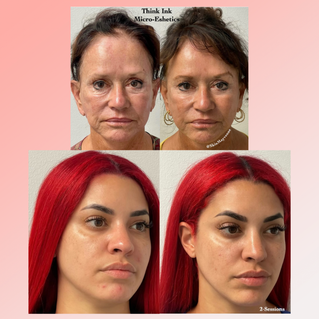Think Ink Micro-Esthetics, trilift, facelift, face tightening, face contouring, microneedling, radio frequency, dynamic muscle stimulation, anti-aging