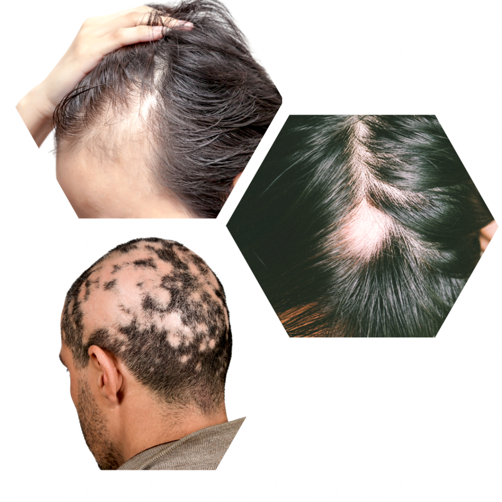 think ink micro esthetics, smp, scalp micropigmentation, scalp micropigmetnation for thinning hair, scalp micropigmentation for hair loss